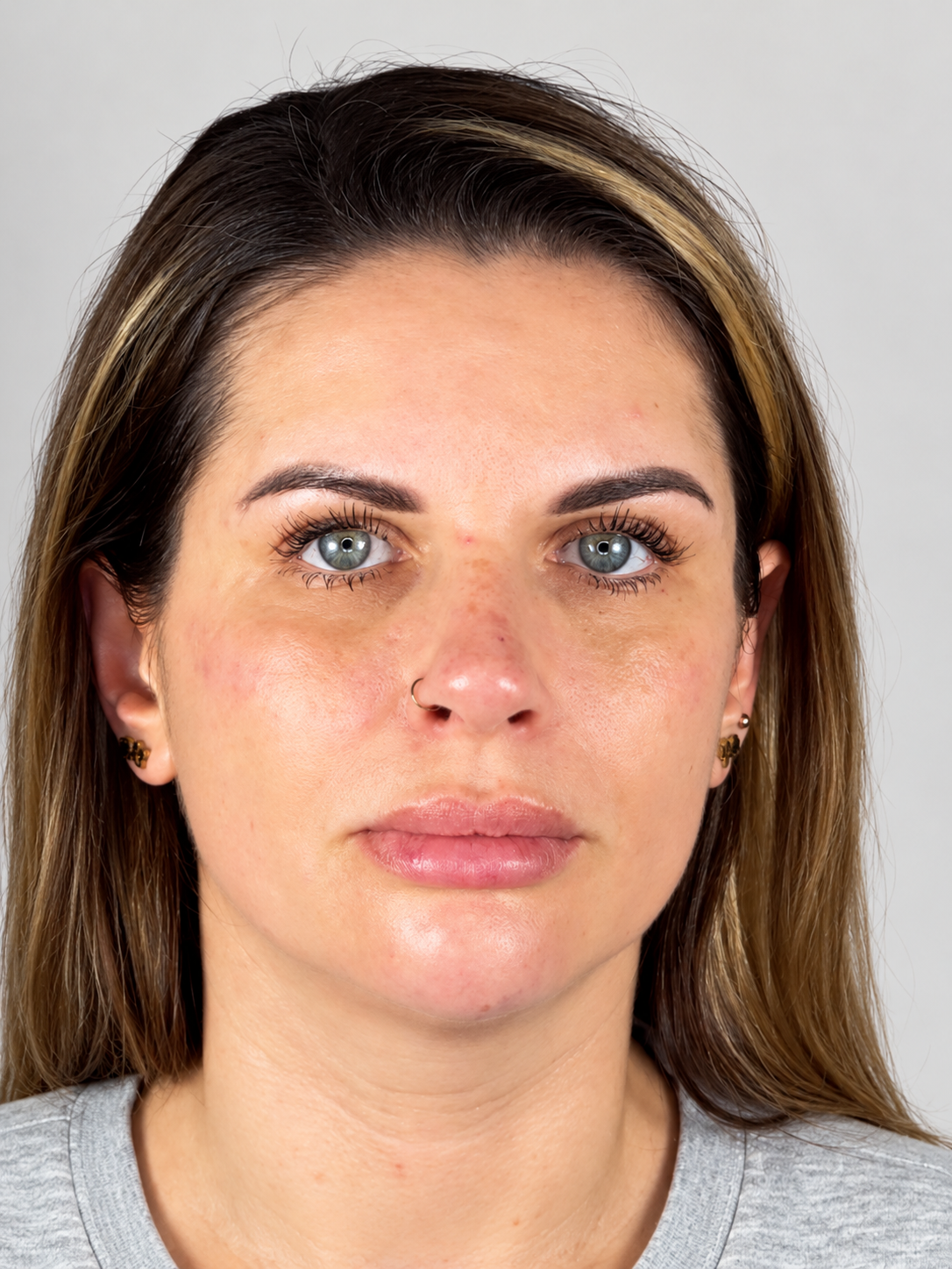 After treatment