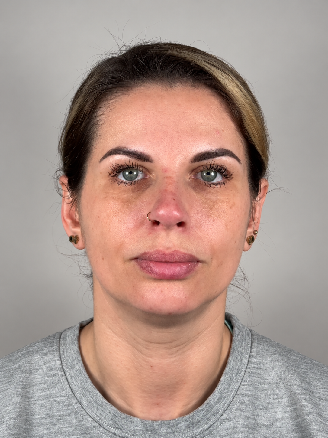 Before treatment