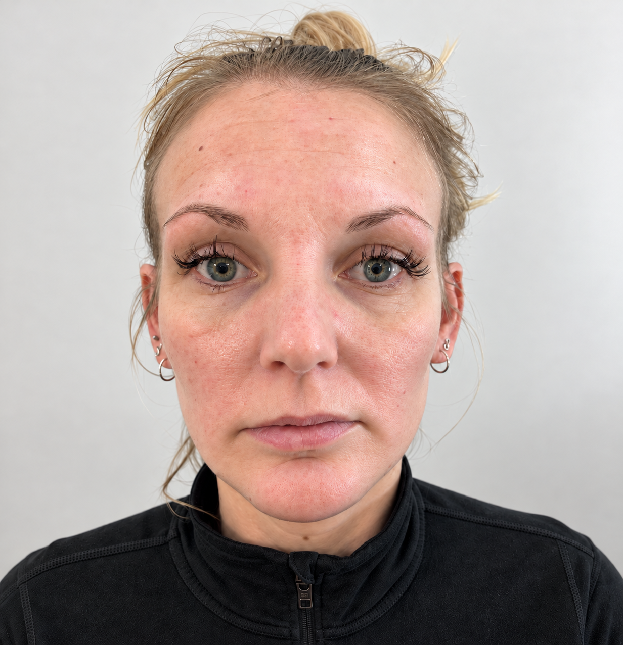Before treatment