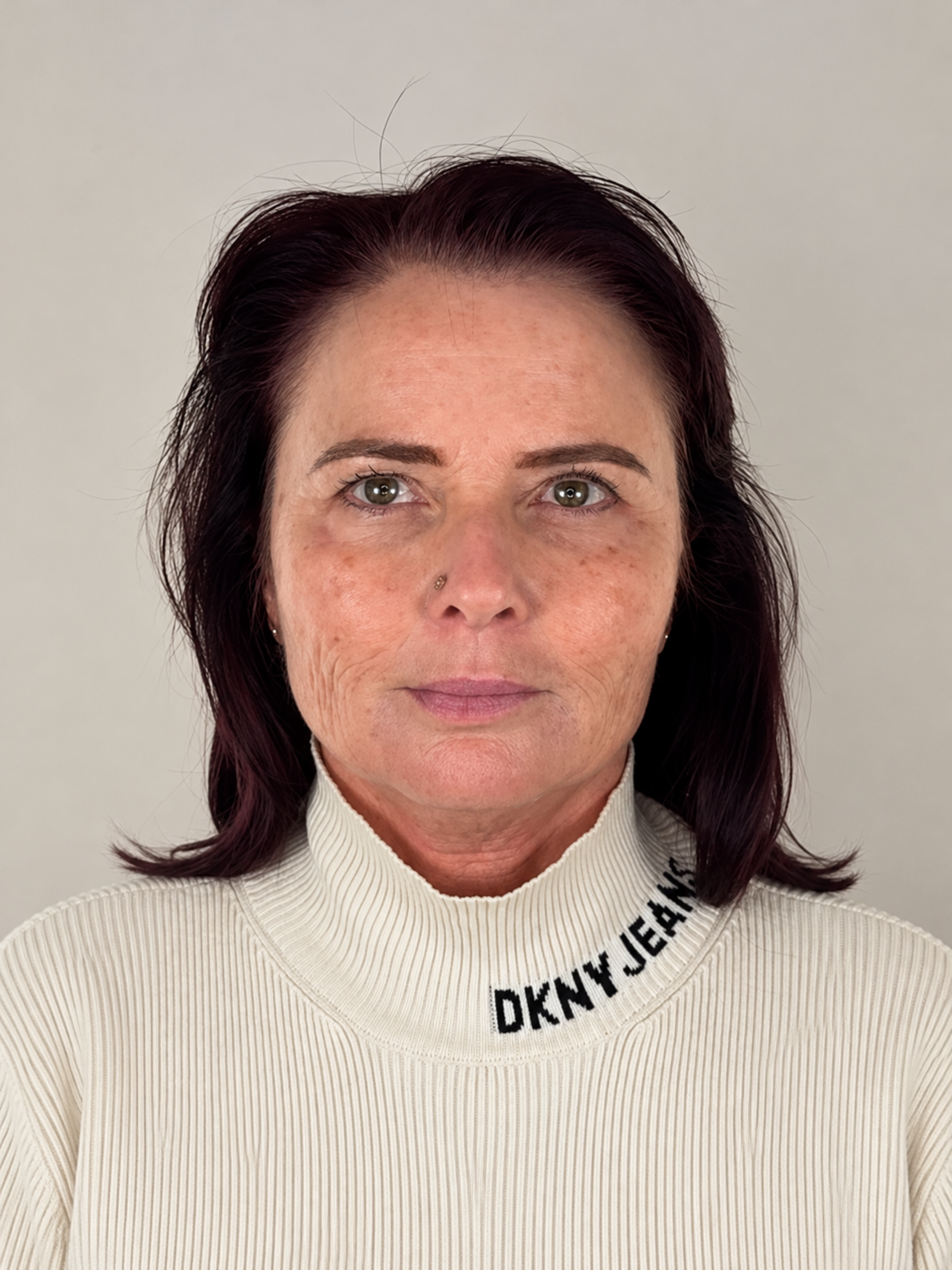 Dermal filler, after treatment