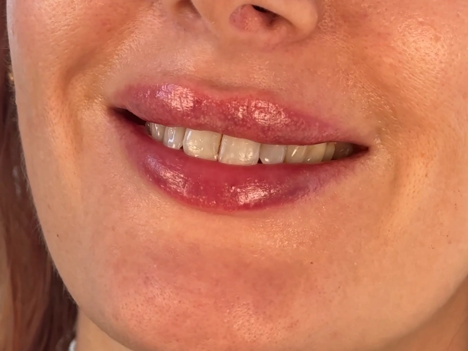 After treatment
