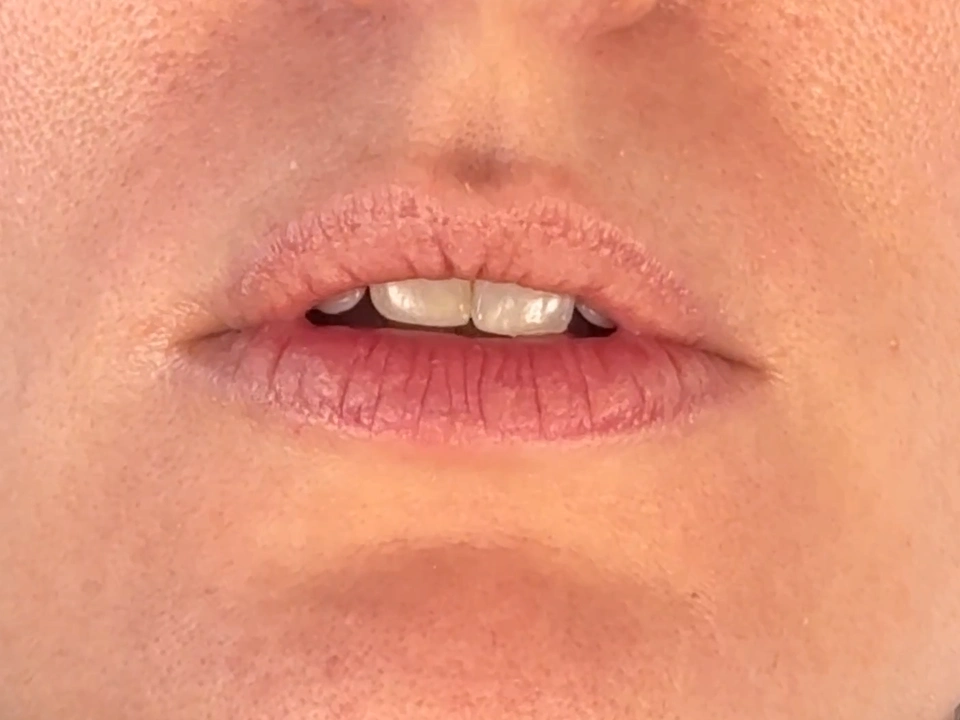 Before treatment