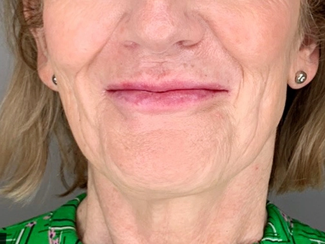 After treatment