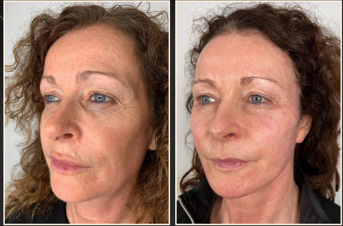 Before treatment