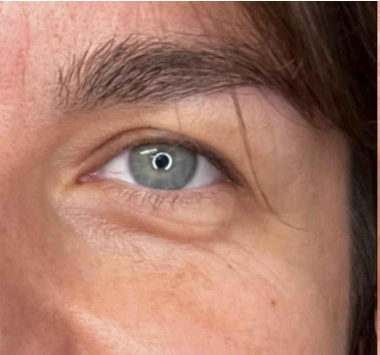 Before treatment