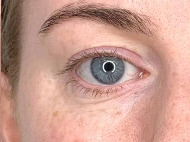 After treatment
