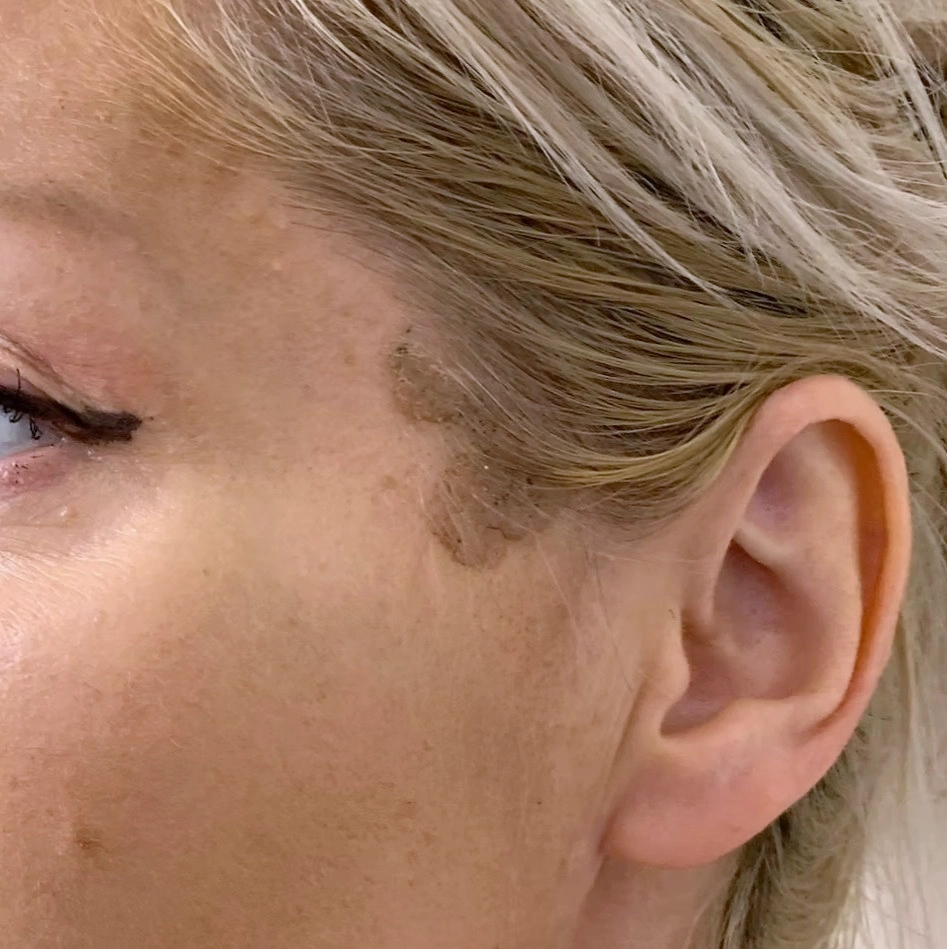 Before treatment