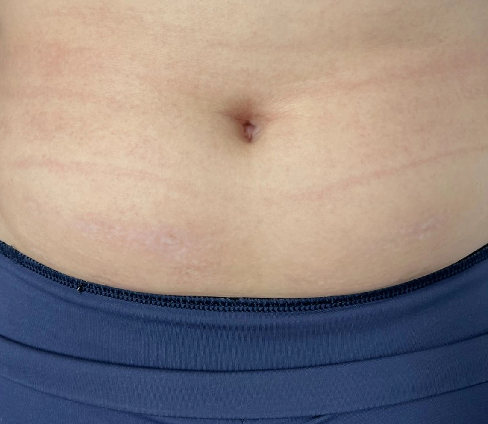 After treatment