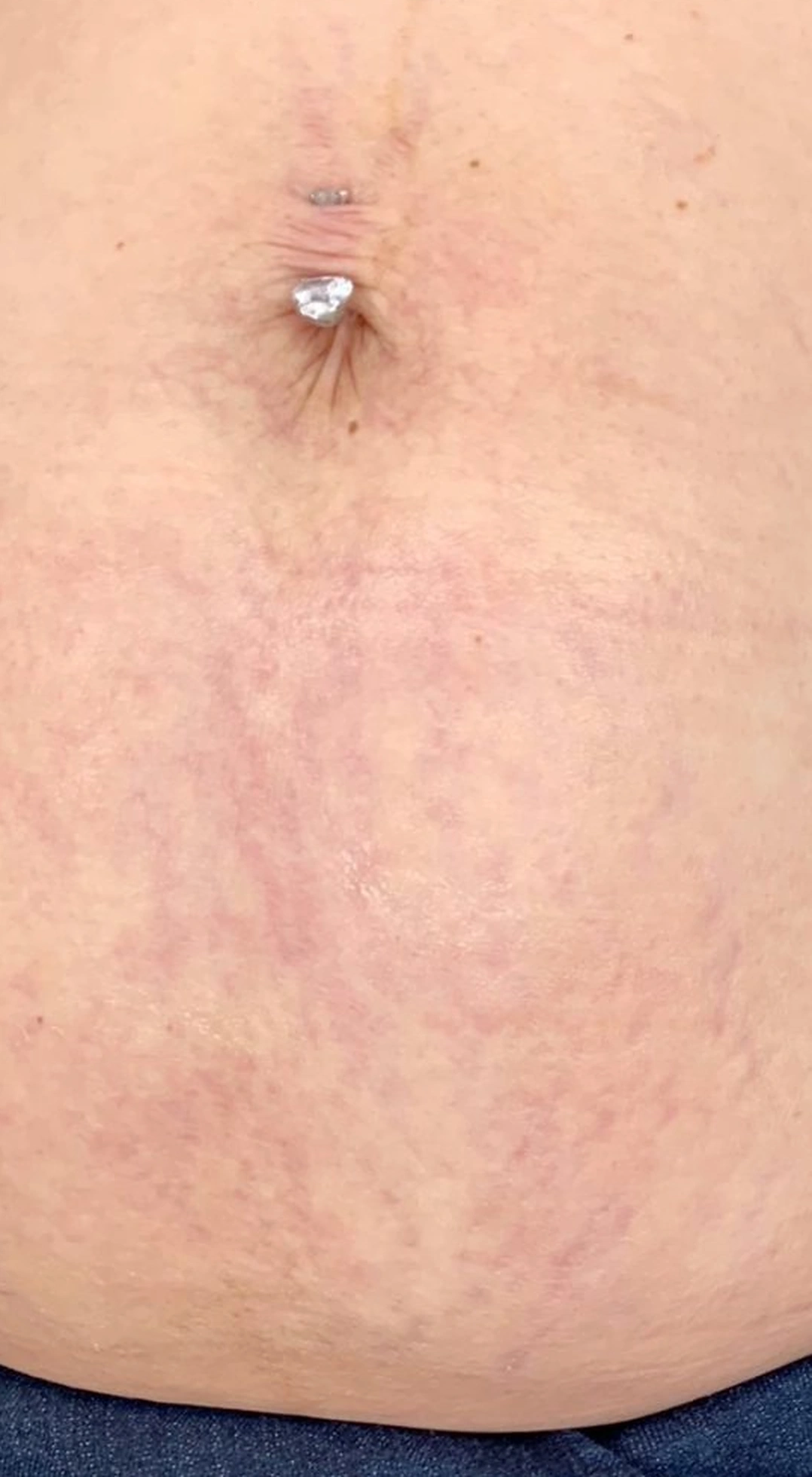 After treatment