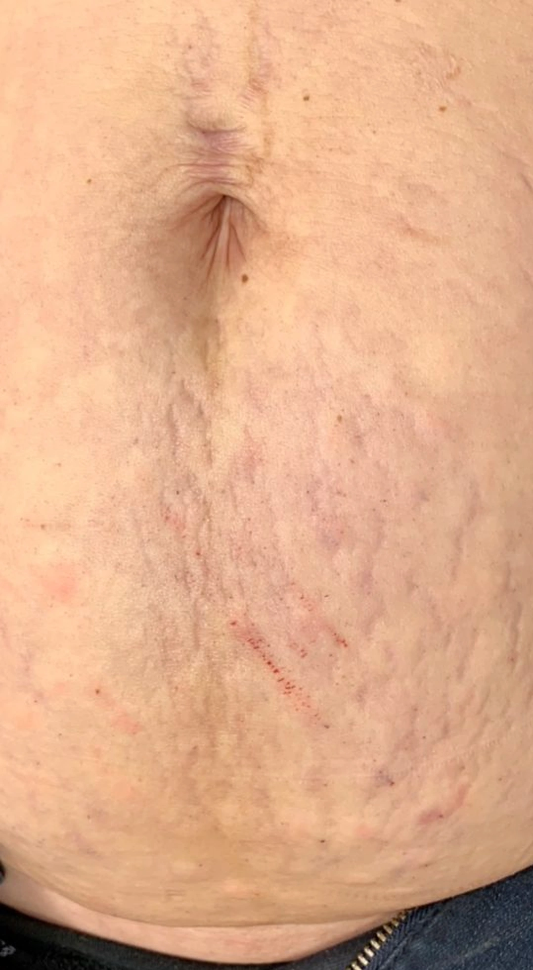 Before treatment