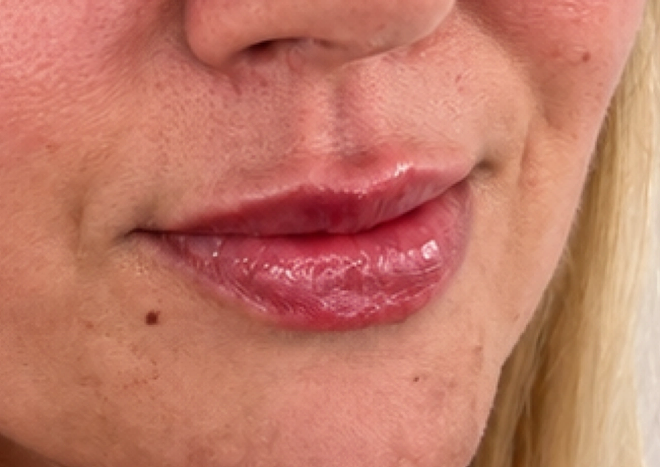 After treatment
