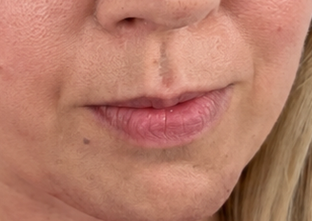 Before treatment