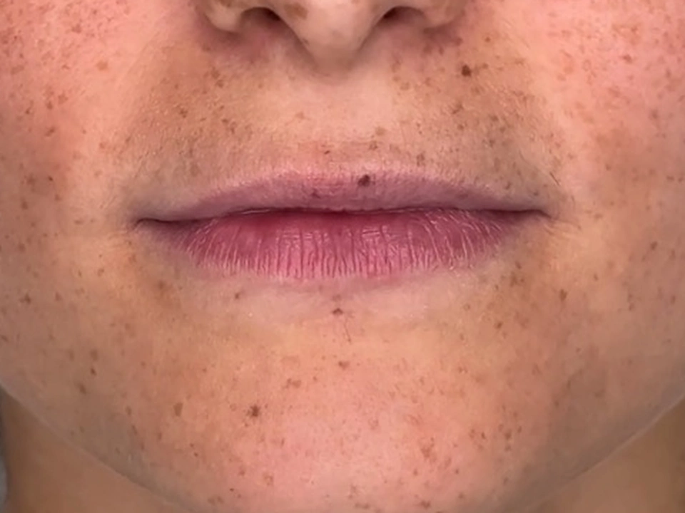 Before treatment