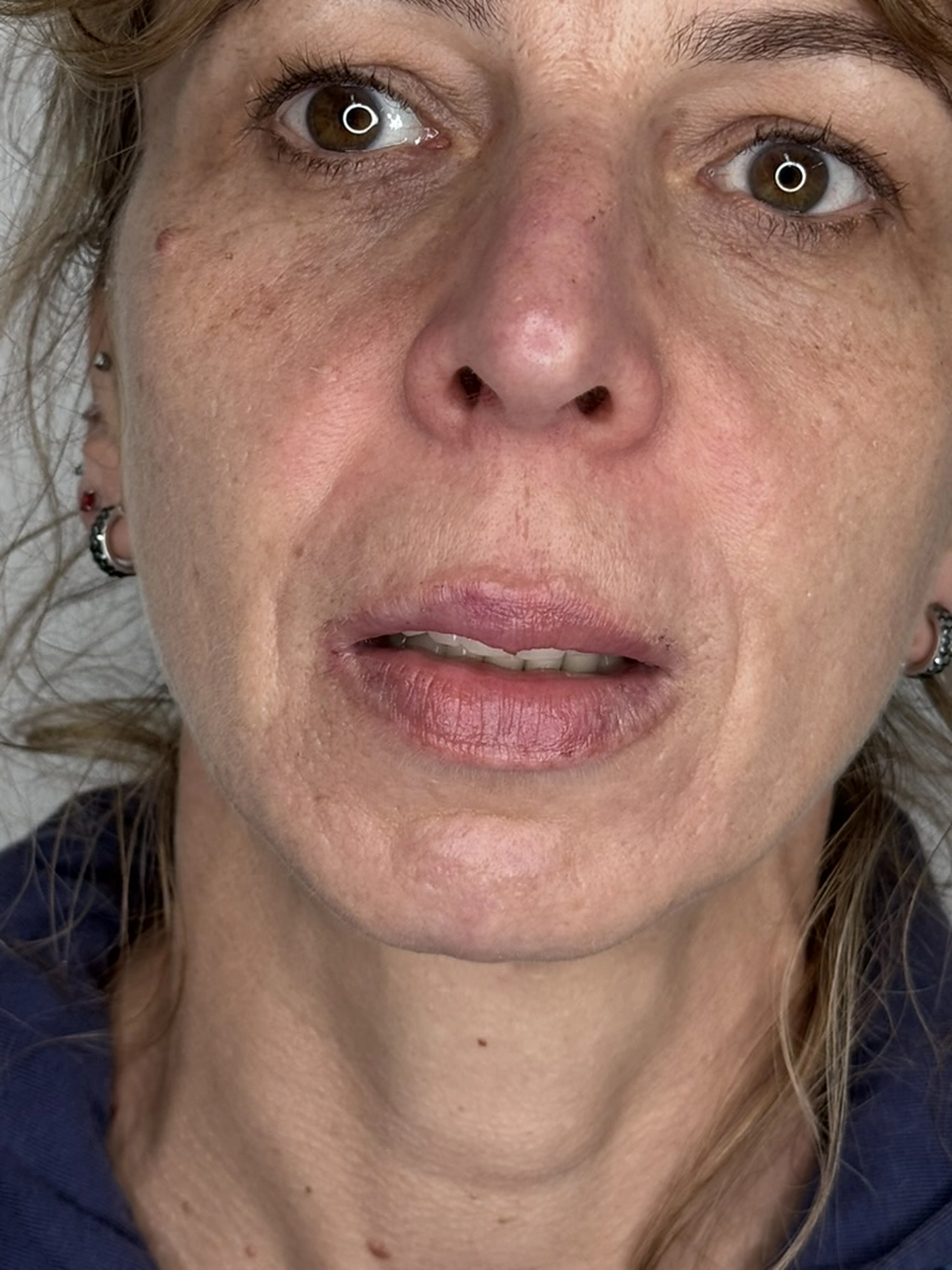 14 days after lip filler treatment