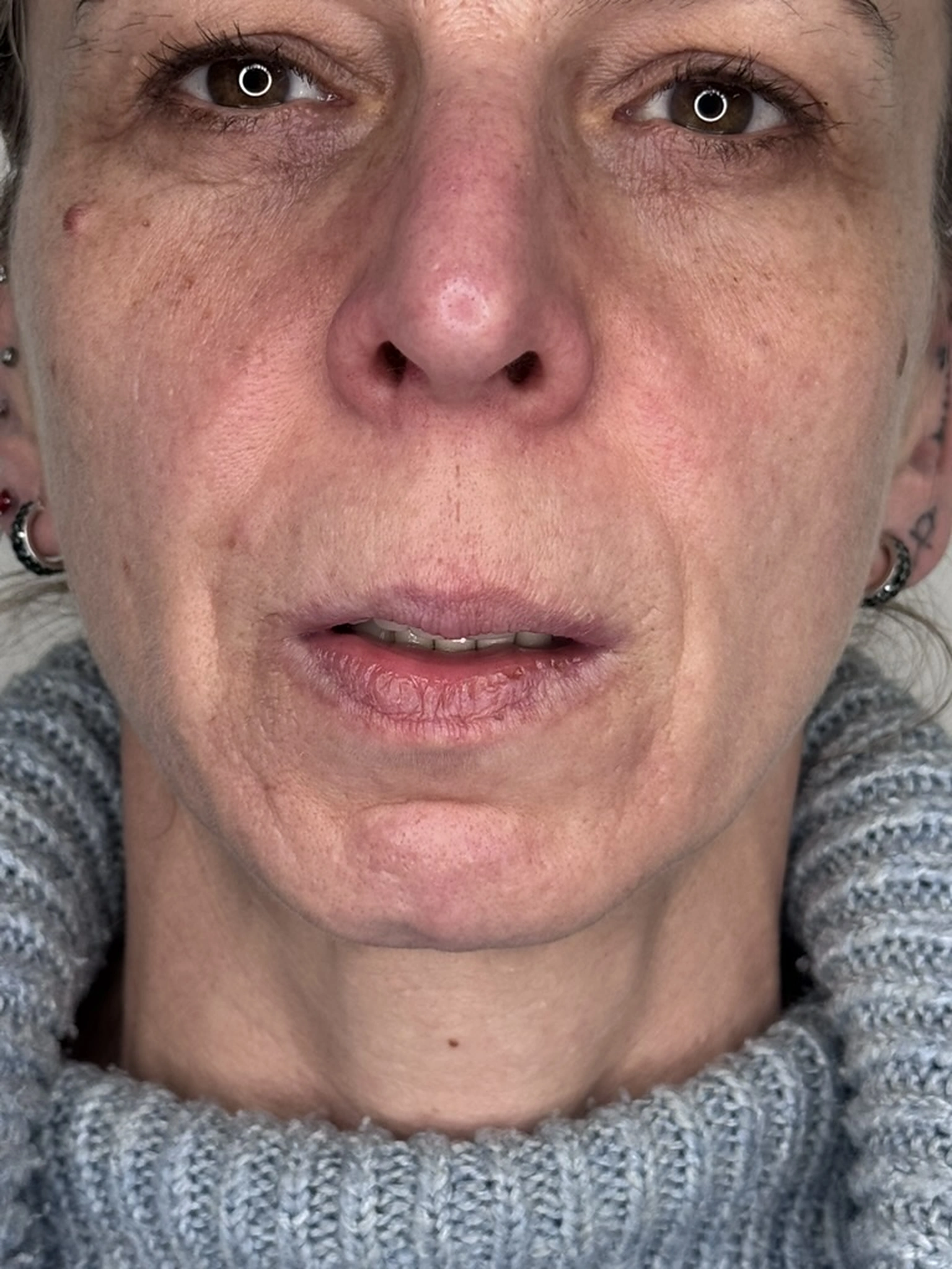 Before lip filler treatment