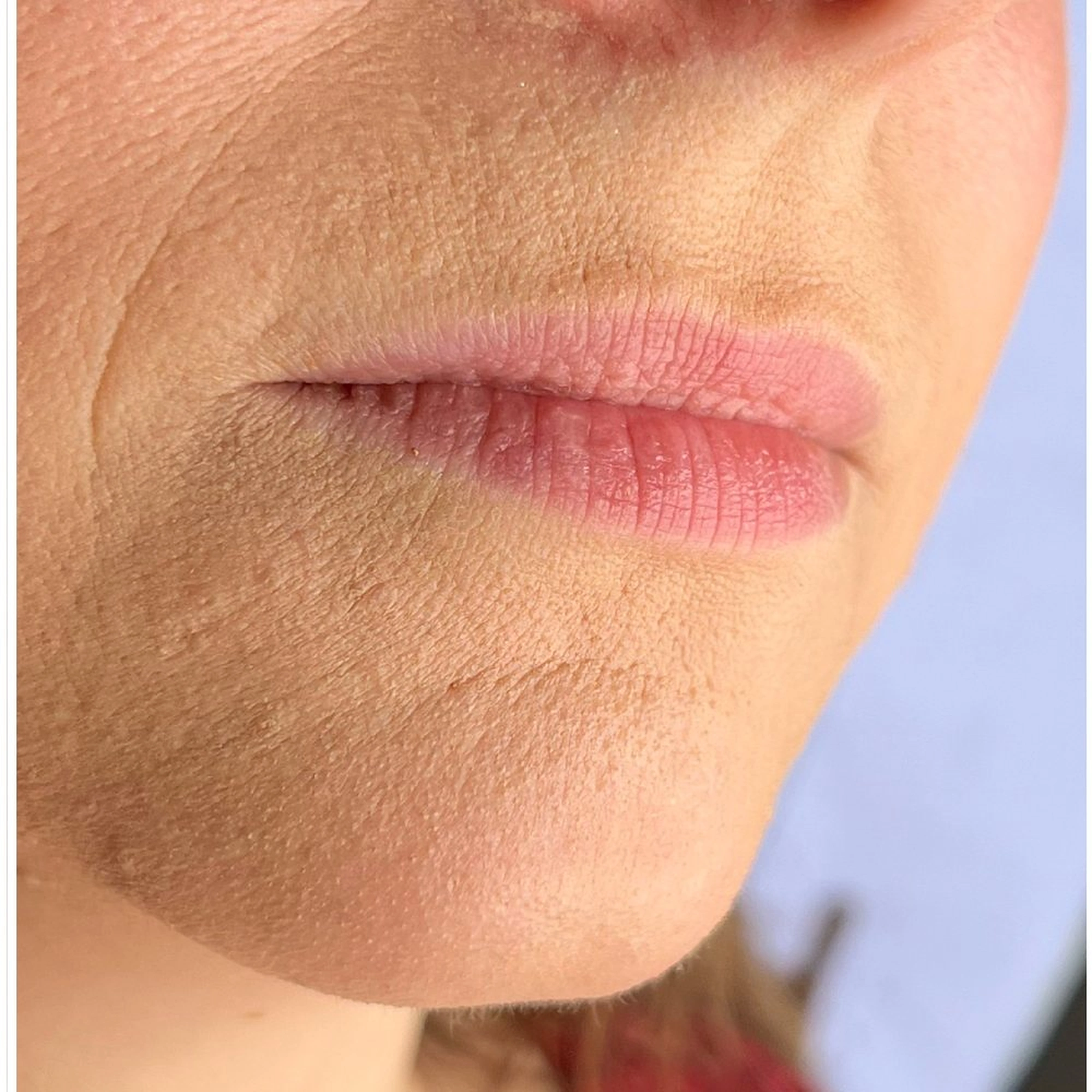 Before treatment