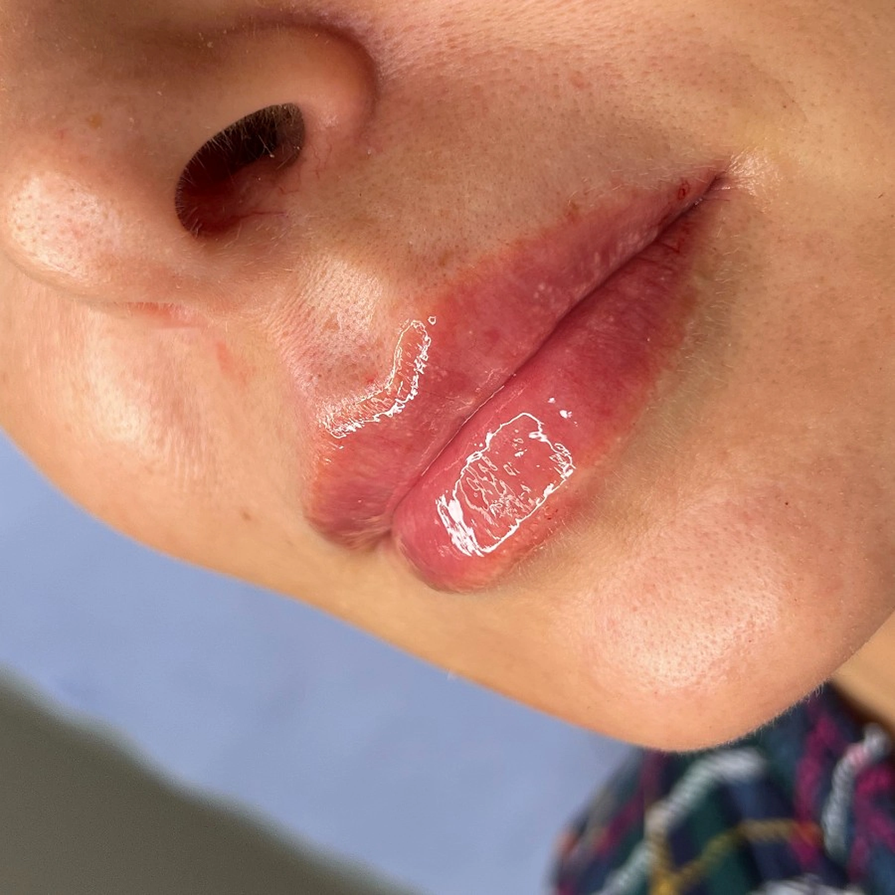 After treatment
