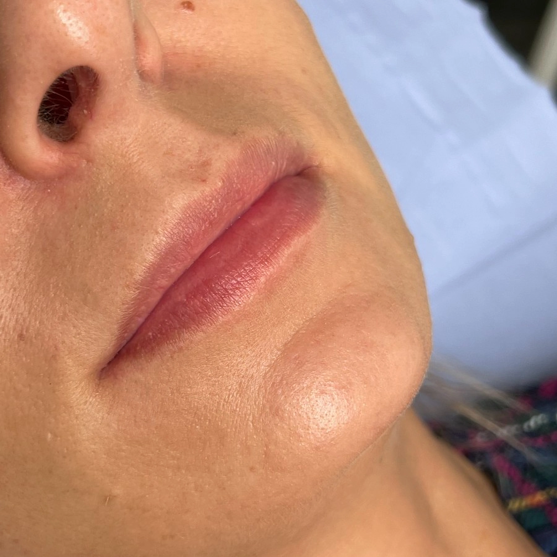 Before treatment
