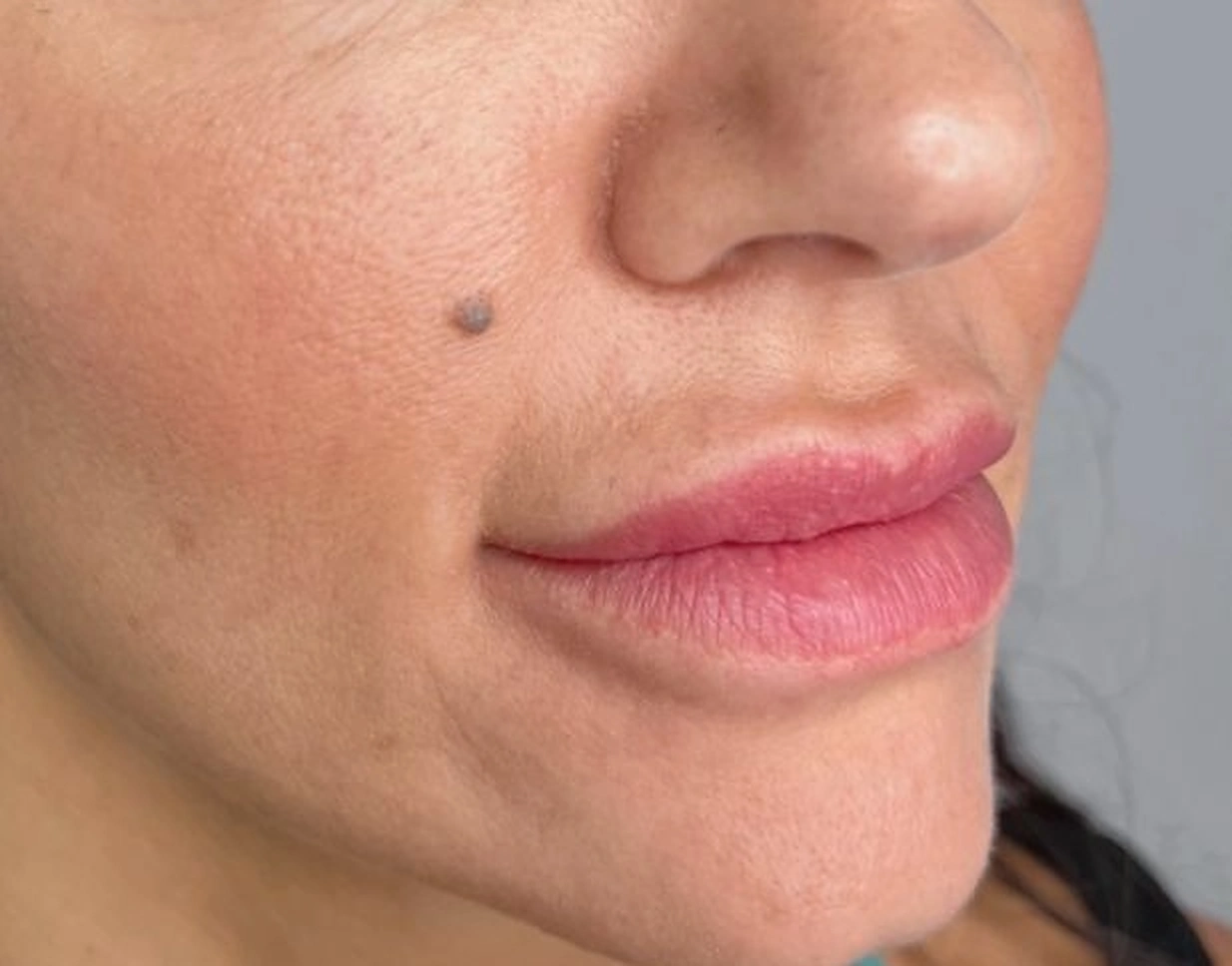 Before treatment