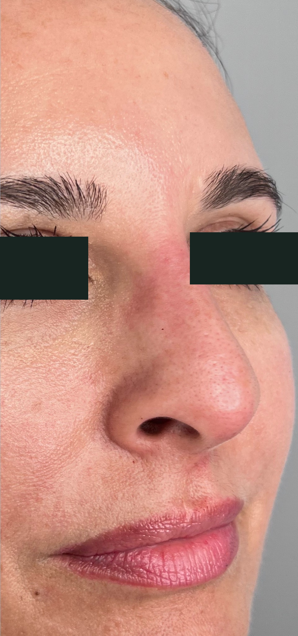 After treatment