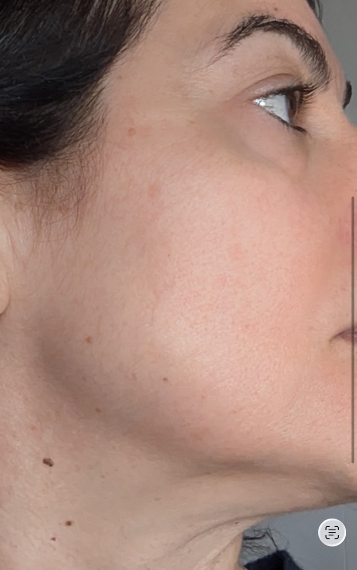 After treatment