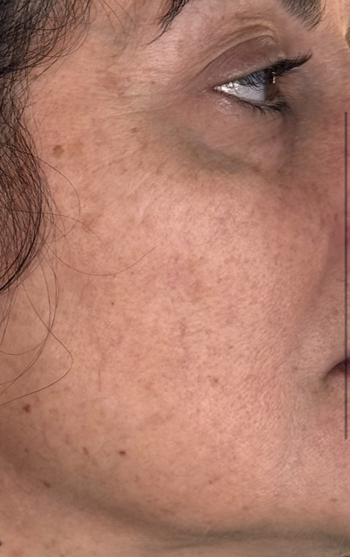 Before treatment