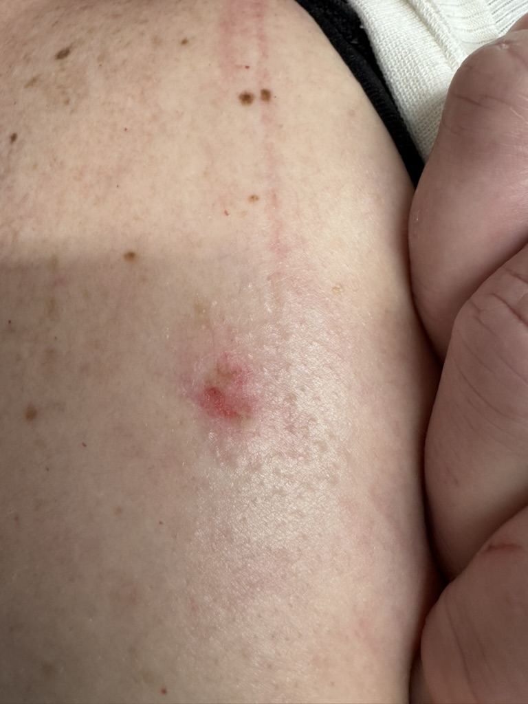 After treatment