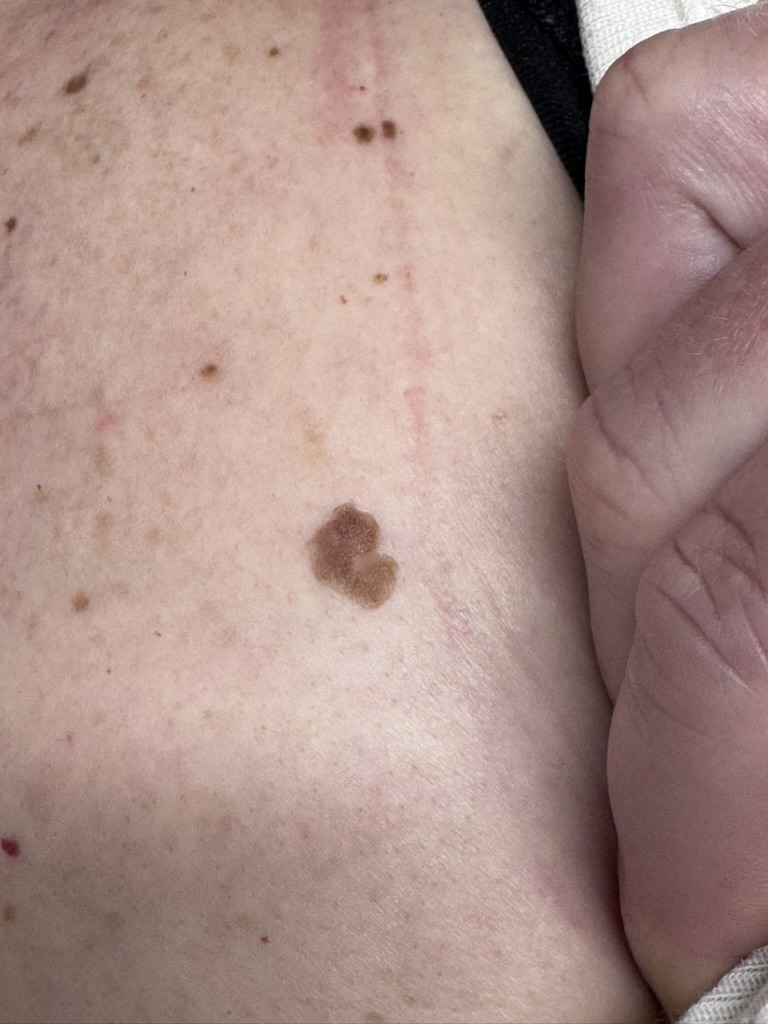 Before treatment