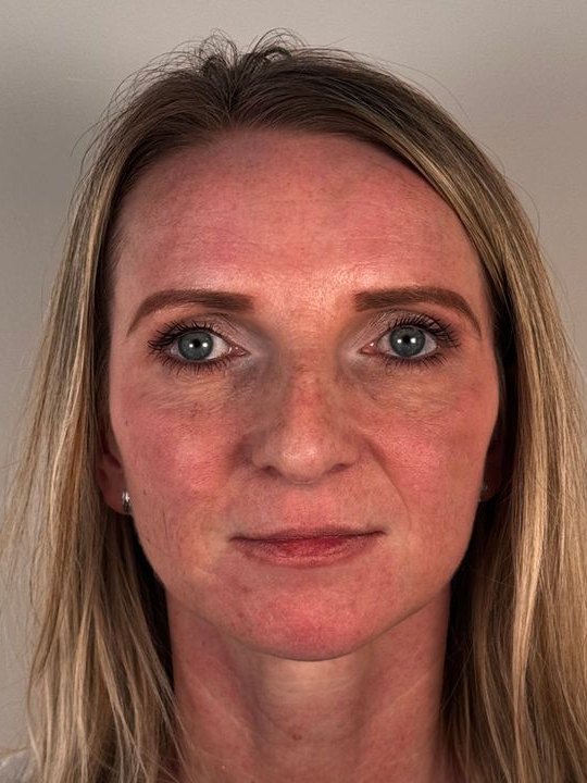 The same patient after full-face structural rejuvenation
