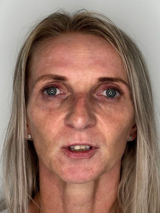 Patient before full-face structural rejuvenation