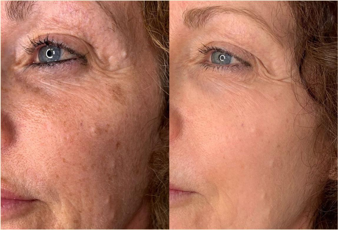 Before treatment