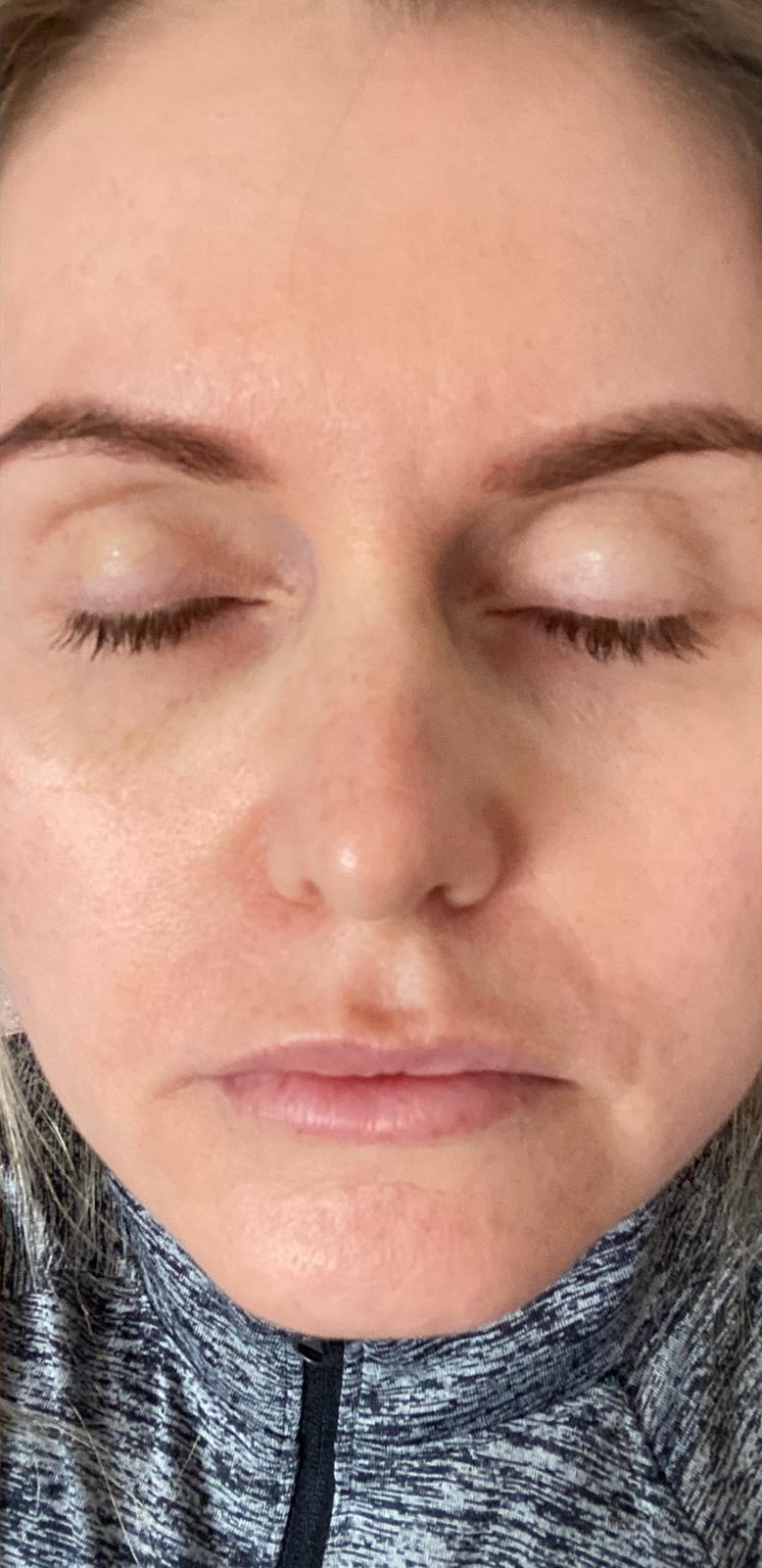 After treatment