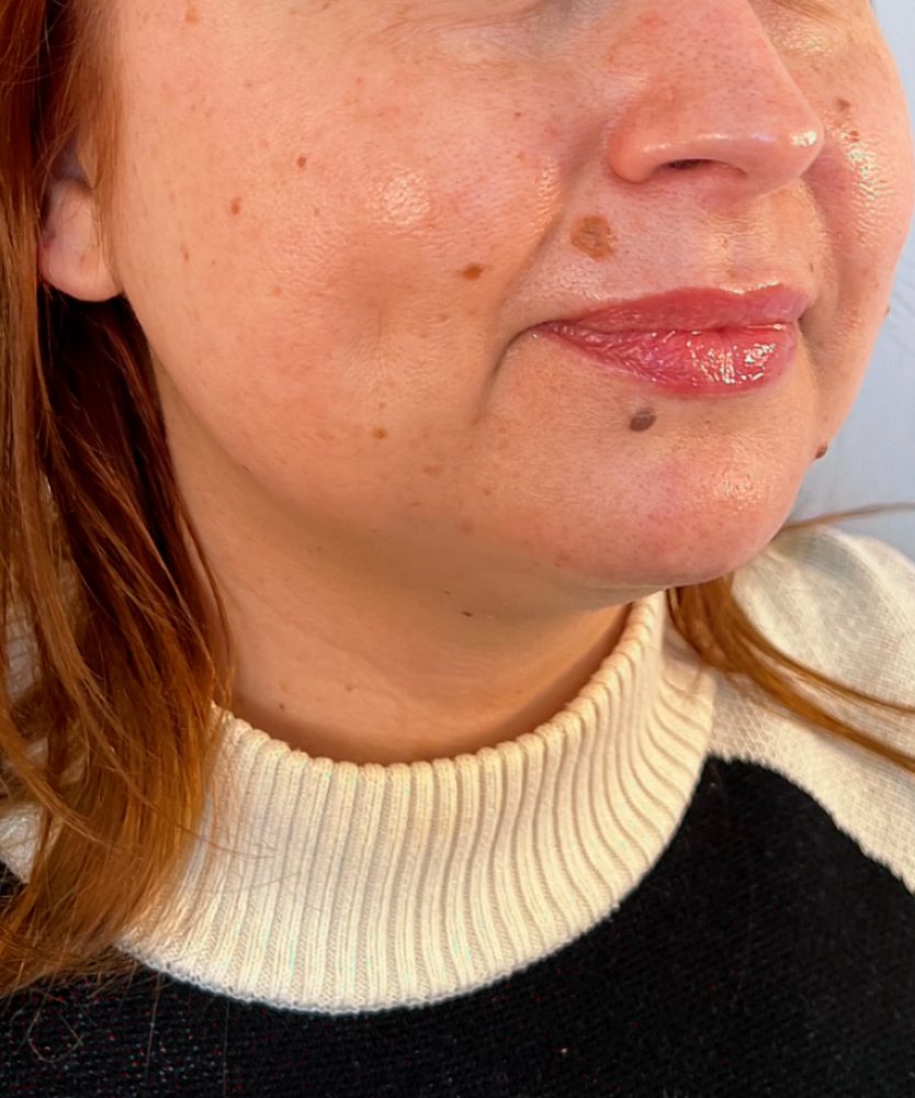Before treatment