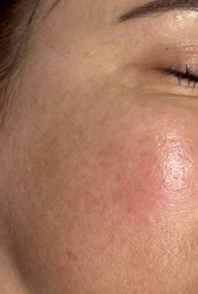 Before treatment