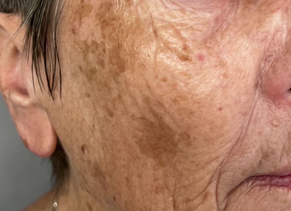 Before treatment