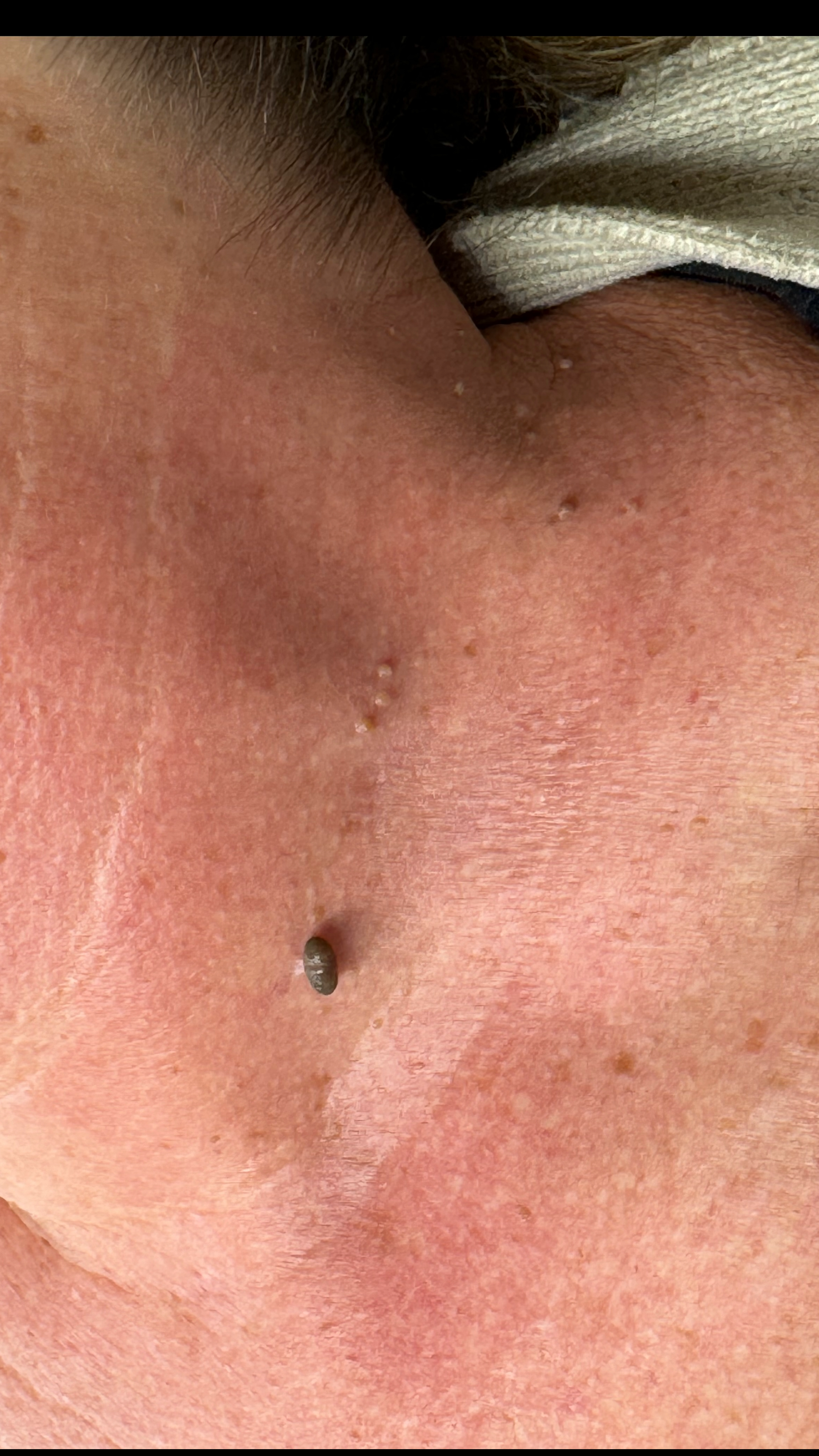 Before treatment