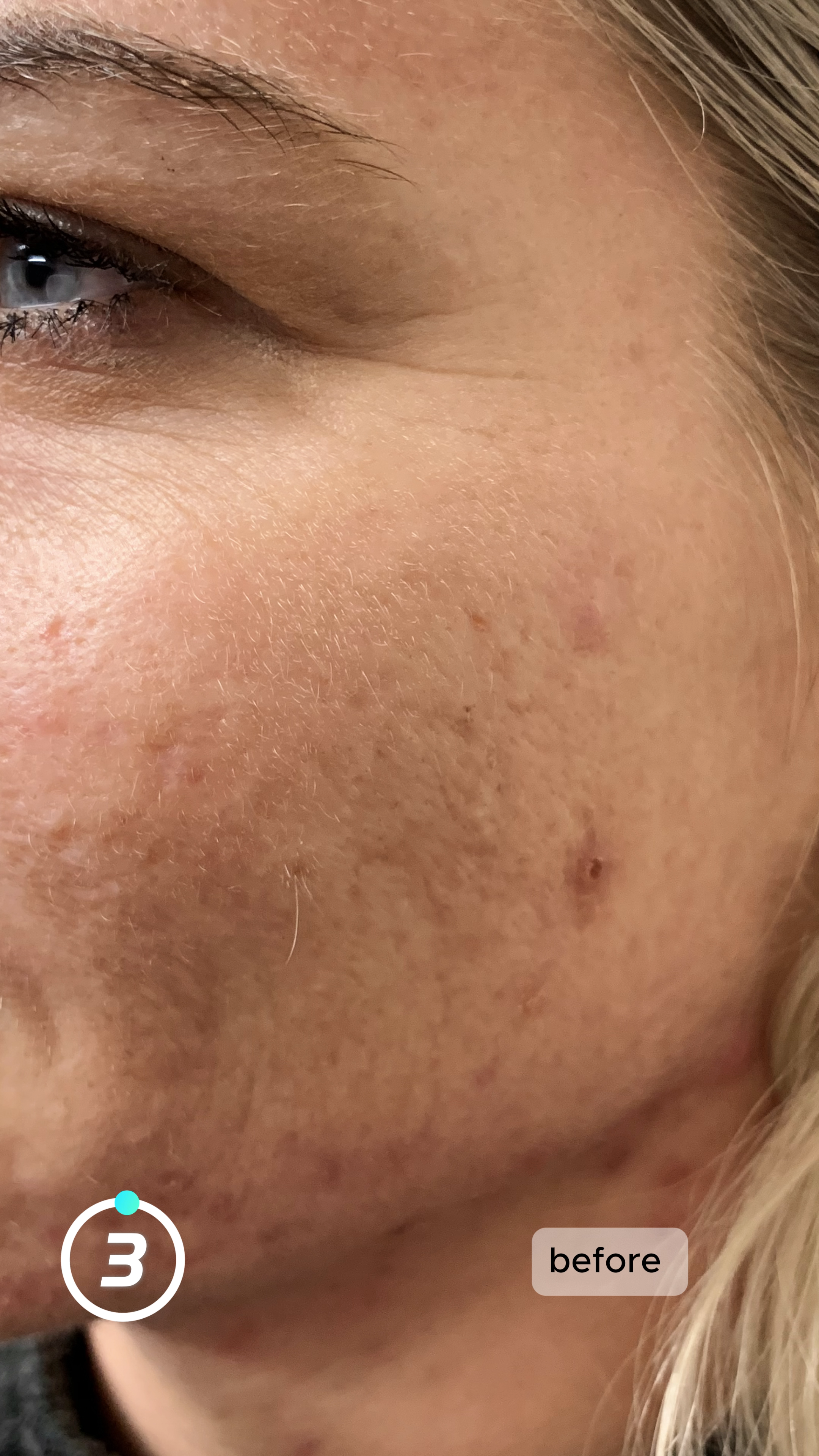 Before treatment