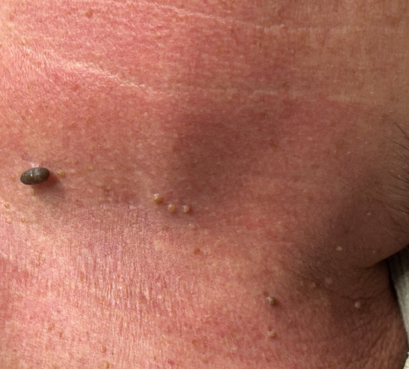 Original example of multiple skin tags on the neck