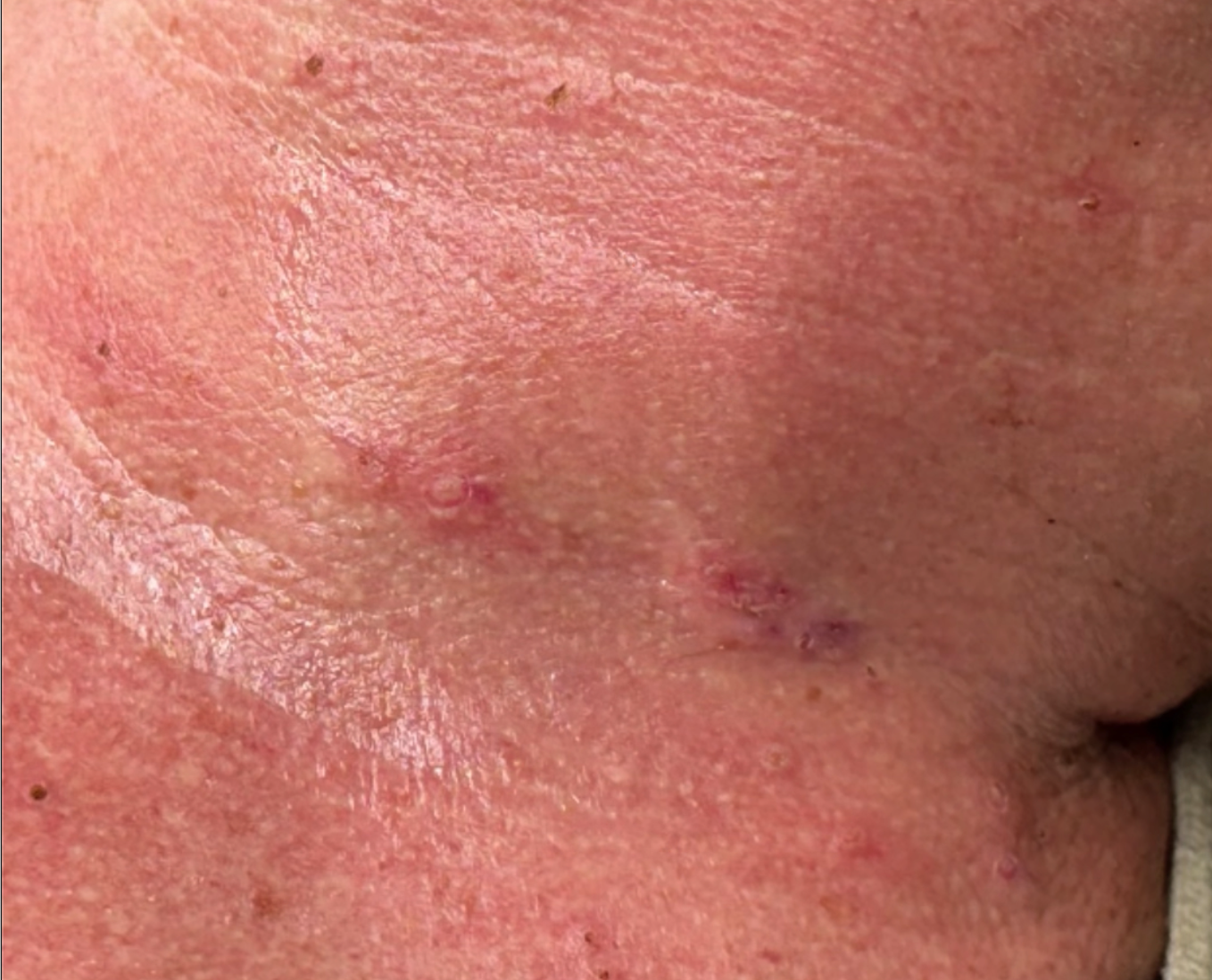 Raised lesions on the neck — 30 minutes after, early post-procedure appearance