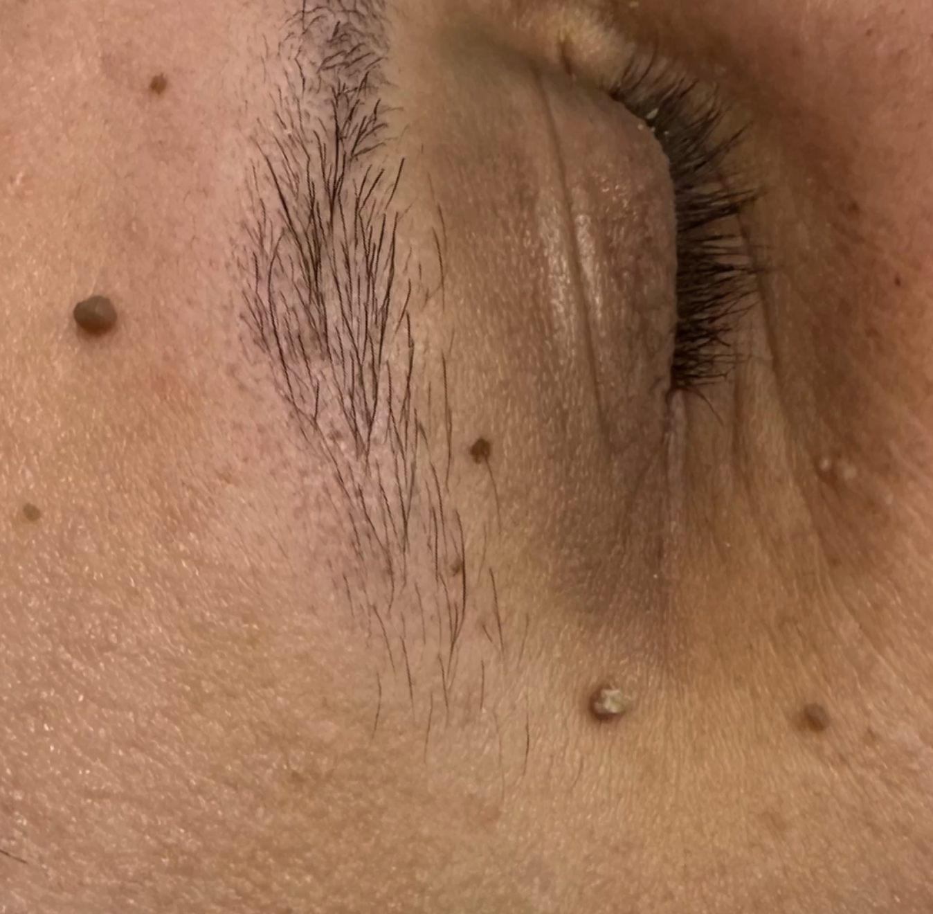 A raised lesion near the brow before treatment
