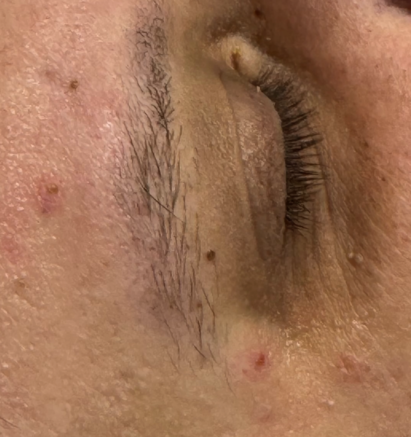A raised lesion near the brow — 5 days after, healing in progress