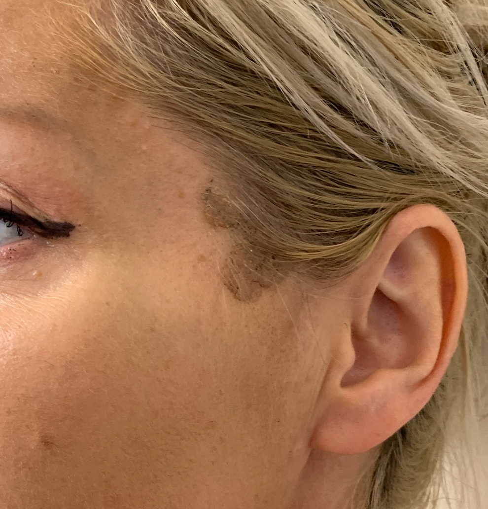 A raised lesion at the temple before treatment