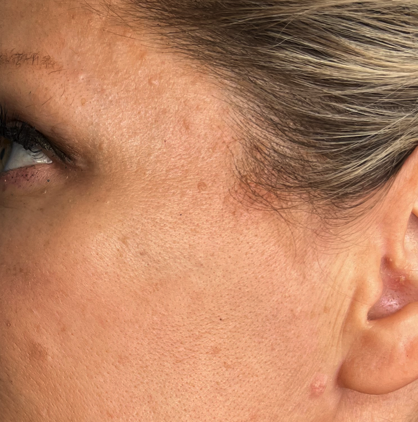A raised lesion at the temple — 7 days after, healing in progress