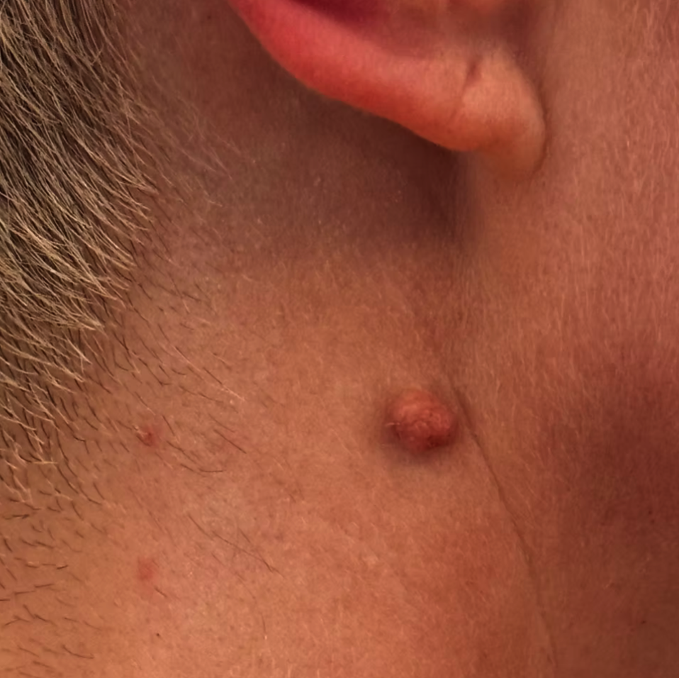 A raised lesion on the neck before treatment