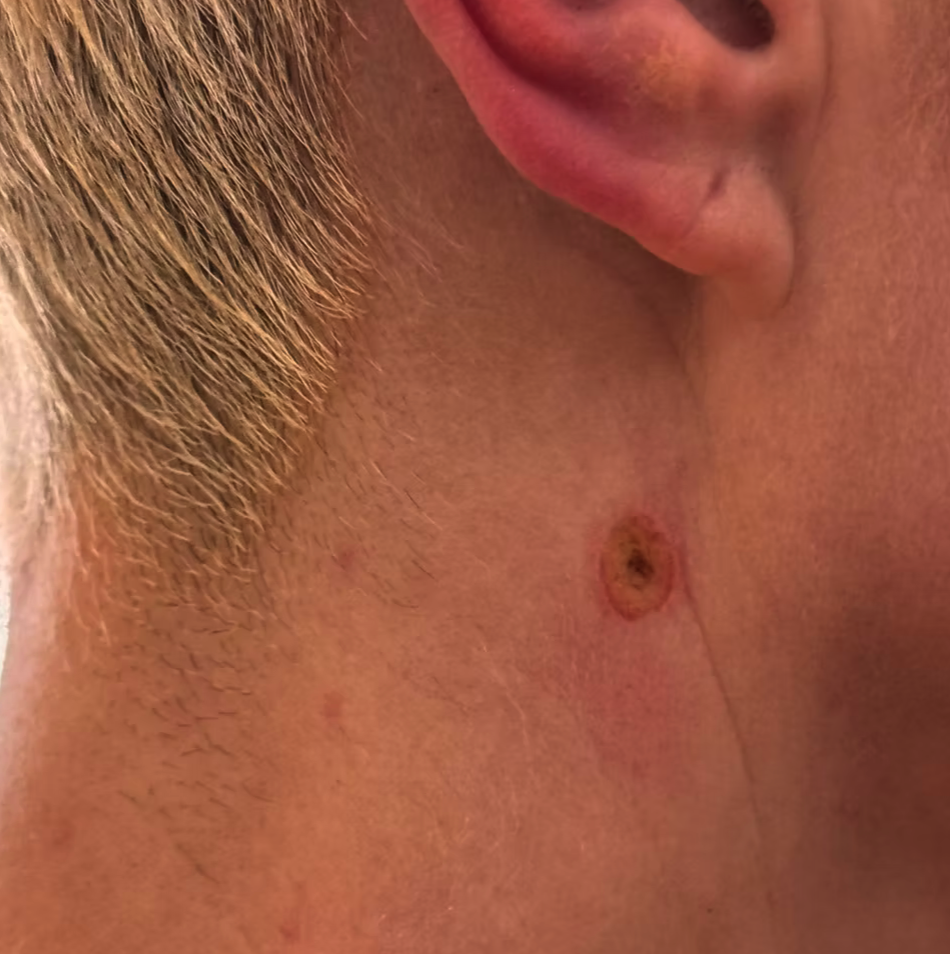 A raised lesion on the neck — immediately after, early post-procedure appearance