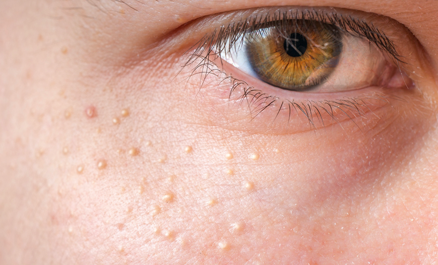 Original example of small white bumps described as milia