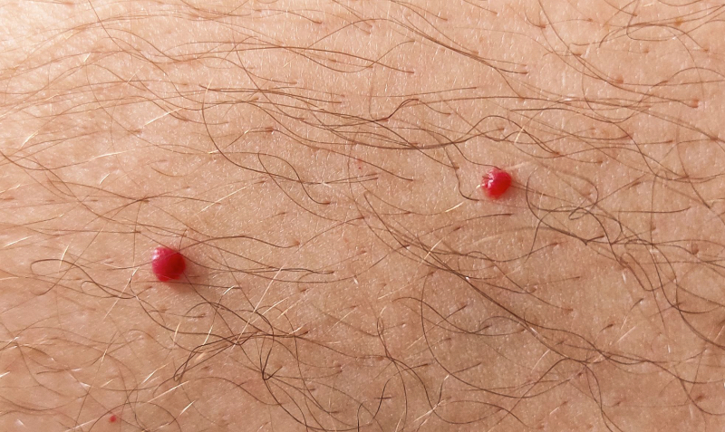 Original example of red spots described as cherry angiomas