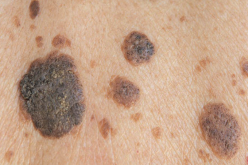 Original example of growths described as seborrhoeic keratoses