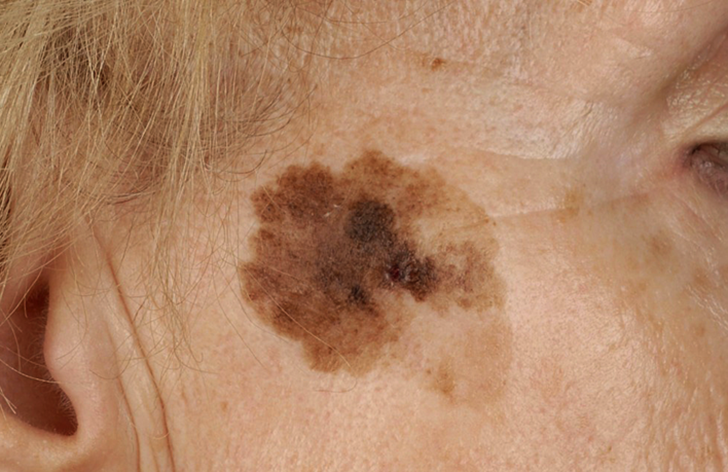 Original example of pigmented marks described as solar lentigines