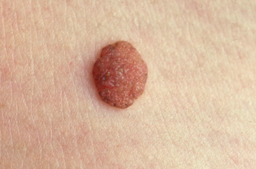 Original example of a raised mole